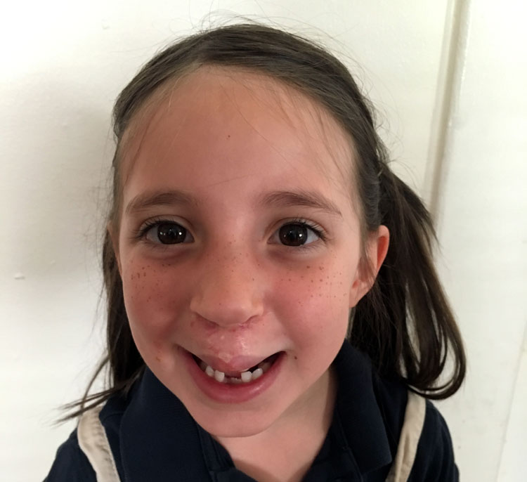 post cleft lip columna surgery